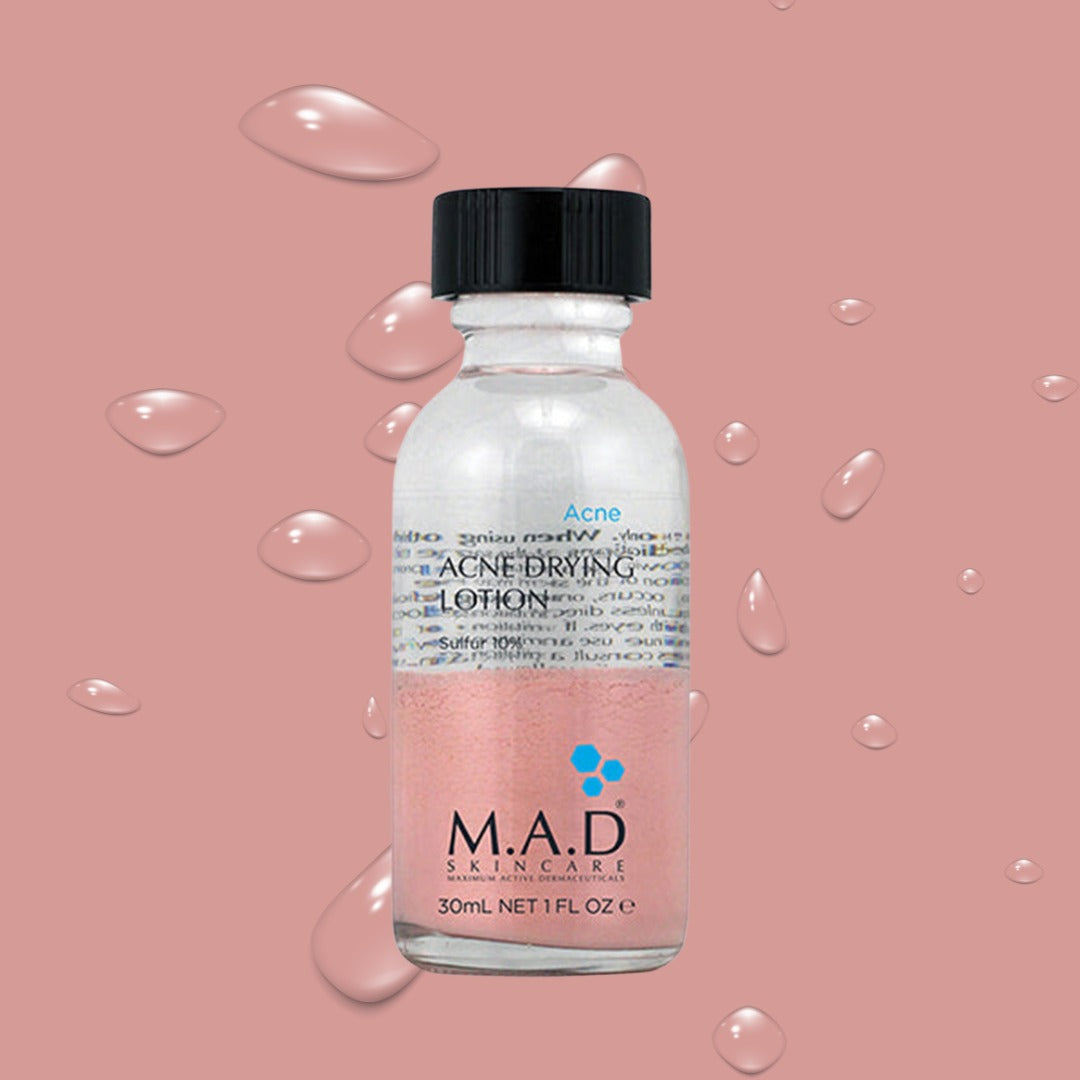 Acne Drying Lotion (30ML)
